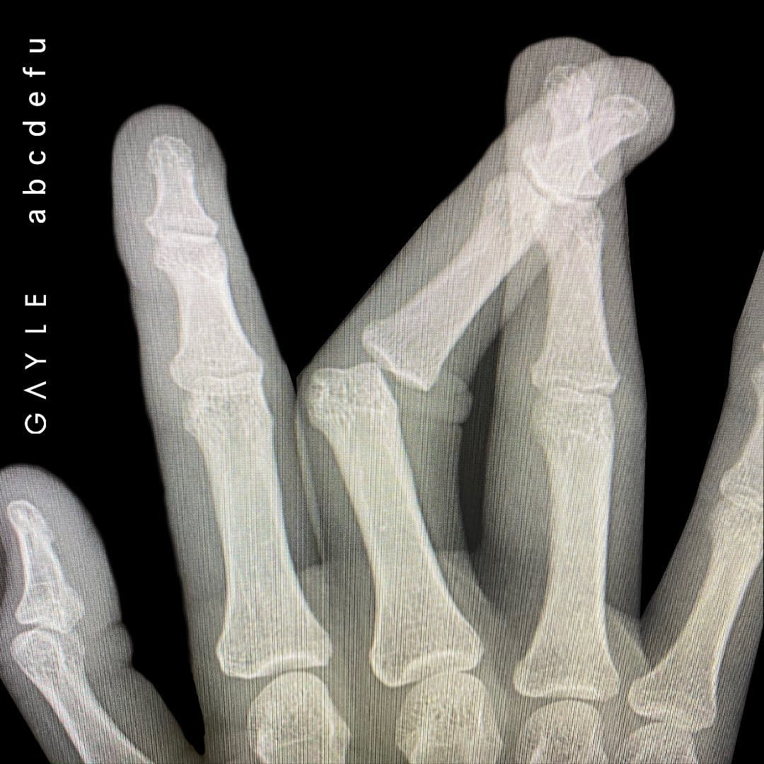 An image of the cover art for the song ABCDEFU in Fortnite festival. This features an x-ray of a hand with a broken finger. 